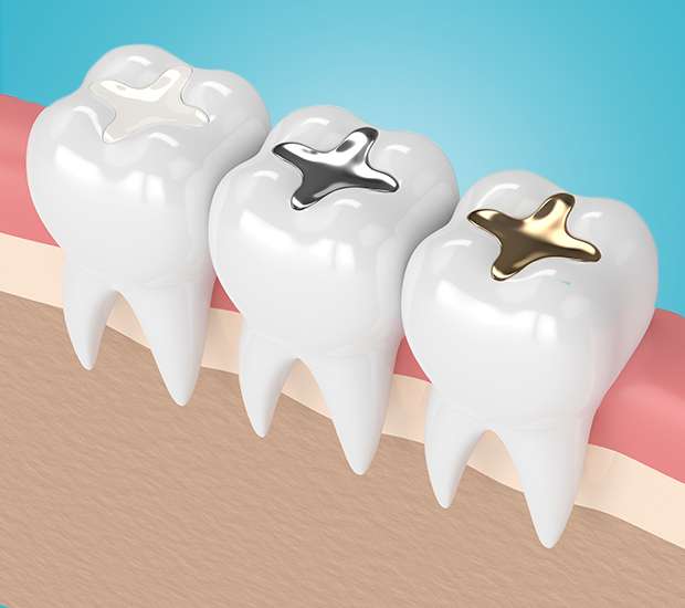 Charleston Composite Fillings