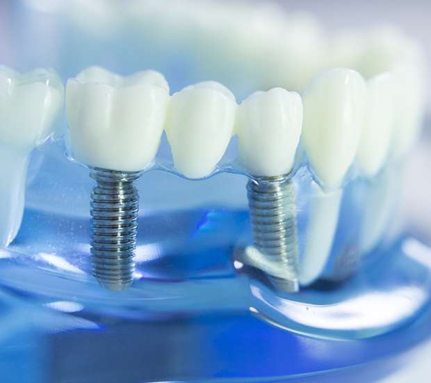 Charleston Dental Implants