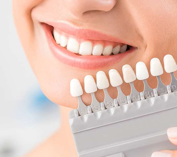 Charleston Dental Veneers and Dental Laminates