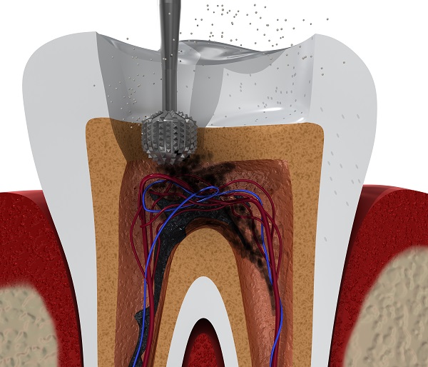 Can A General Dentist Receive Endodontic Training To Perform Periodontic Care?